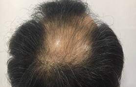 hair restoration patient 2