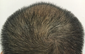 hair restoration patient 4
