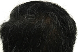 hair restoration patient 5