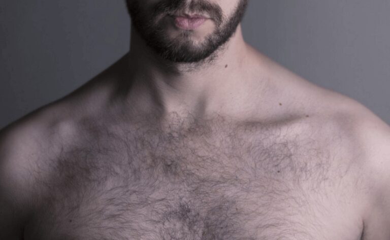 Body Hair Transplant