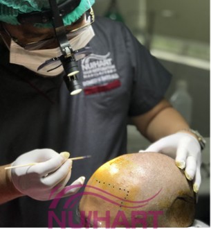 hair transplant surgery