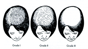 female baldness