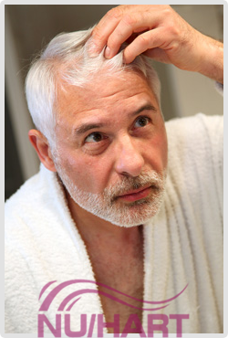 hair loss age