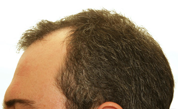 hair loss on men 2