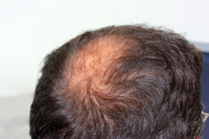 hair loss on men