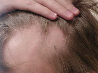 Other Hair Loss Problems | What is Alopecia Areata?