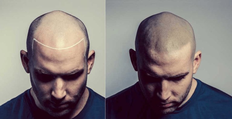 Scalp micropigmentation: cost, success, side effects, maintainence