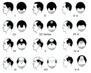 hair loss in men