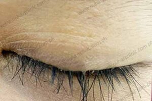 eyelash hair transplant before and after