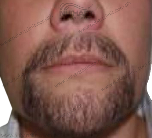 beard hair transplant before and after