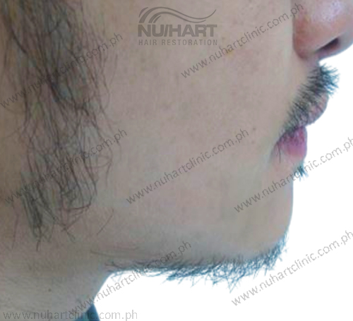 beard hair transplant before and after