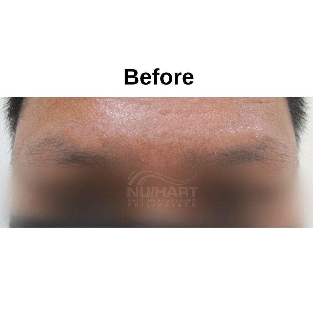 Eyebrow Hair Transplant Photos