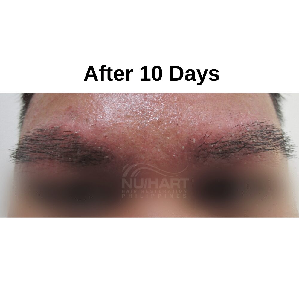 Eyebrow Hair Transplant Photos