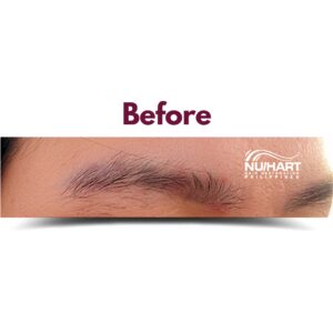 Eyebrow hair transplant before the procedure