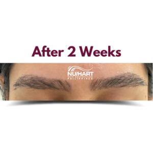 eyebrow hair transplant recovery after two weeks