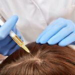 SVF hair treatment Philippines