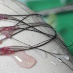 Long Hair FUE Transplant