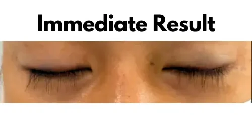 Eyelash hair restoration result