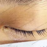 eyelash hair transplant before and after