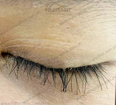 eyelash hair transplant before and after