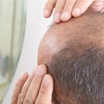 regenera-activa-hair-loss-treatment-philippines.jpg Regenera Activa hair loss treatment at NU/HART Philippines